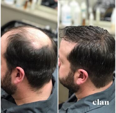 Hair Fixing in Kolkata