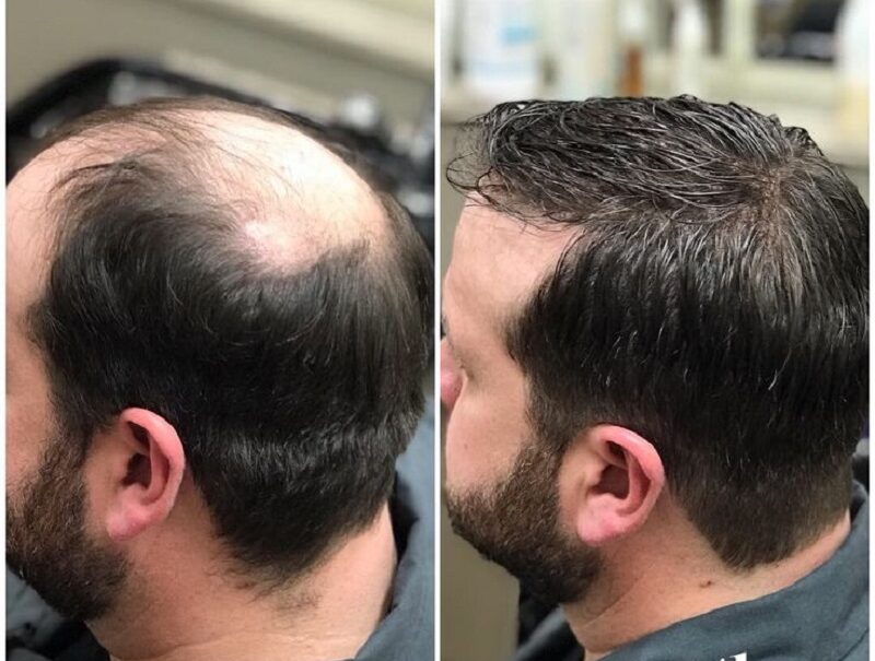 Hair Fixing in Kolkata