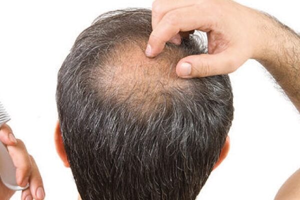 Non Surgical Hair Replacement in Kolkata