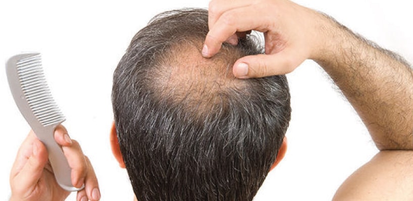 Non Surgical Hair Replacement in Kolkata