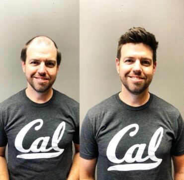 Best Non-Surgical Hair Replacement Centre in Kolkata