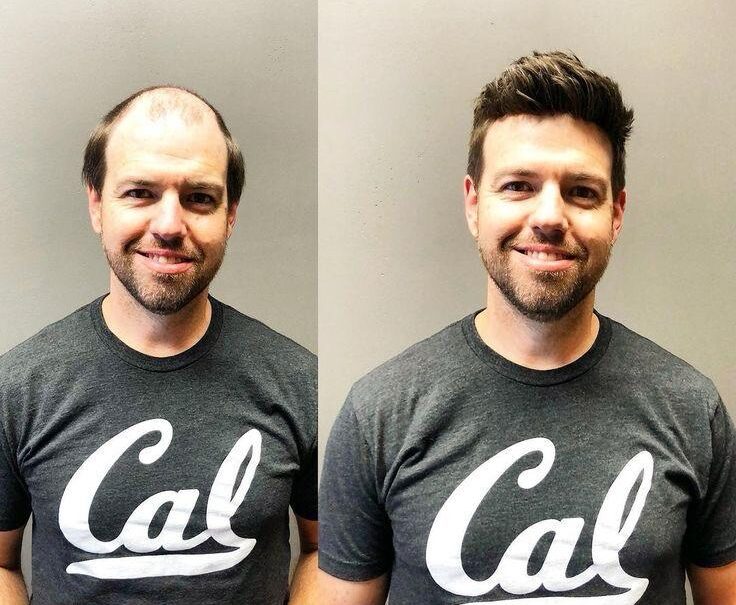 Best Non-Surgical Hair Replacement Centre in Kolkata