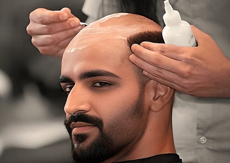 Non Surgical Hair Replacement Service Centre in Kolkata