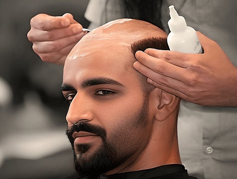 Non Surgical Hair Replacement Service Centre in Kolkata