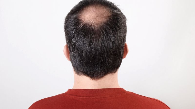 Hair Loss Solutions in Kolkata