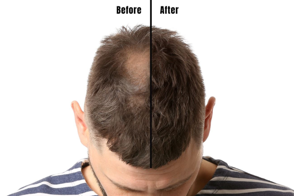 Hair Replacement for Men in Kolkata