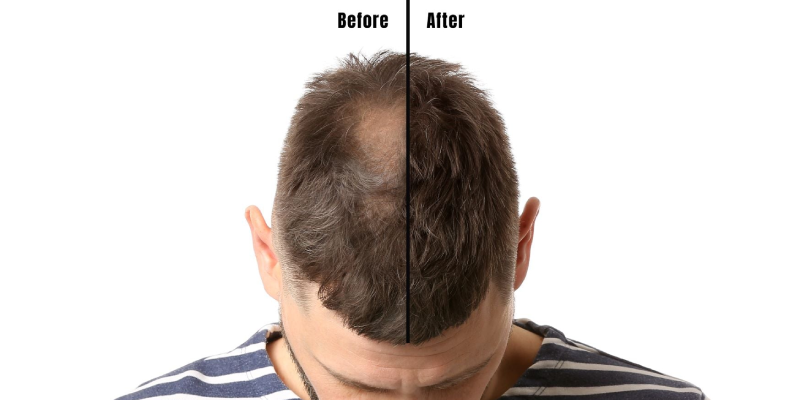 Hair Replacement for Men in Kolkata