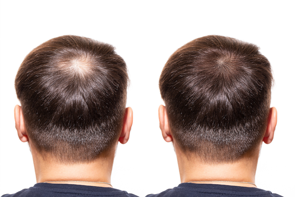 Non-Surgical Hair Replacement in Kolkata