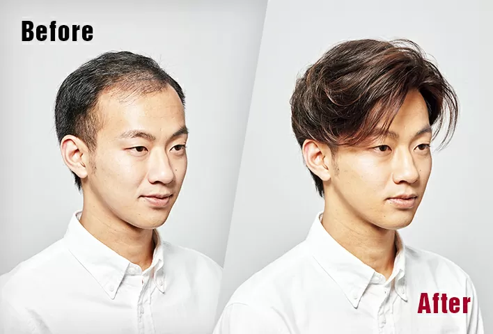 Hair Fixing in Kolkata 