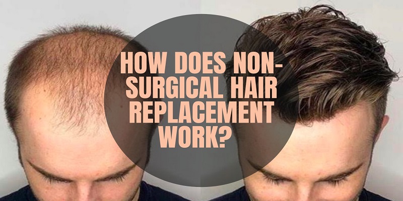 Non Surgical Hair Replacement Solution in Kolkata