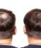 Get Best Non Surgical Hair Restoration in Kolkata at A.K. Hair Wigs