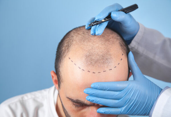 Solve The Baldness At A.K. Hair Wigs, Hair Fixing Studio Kolkata