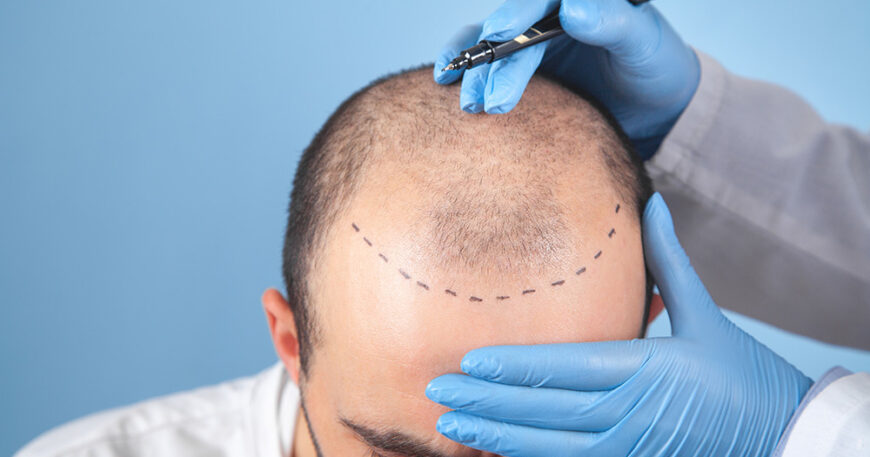 Solve The Baldness At A.K. Hair Wigs, Hair Fixing Studio Kolkata