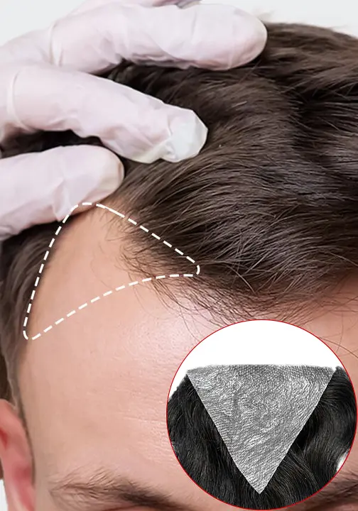 Premium Hair Patches in Kolkata for Men At A.K Hair Wigs