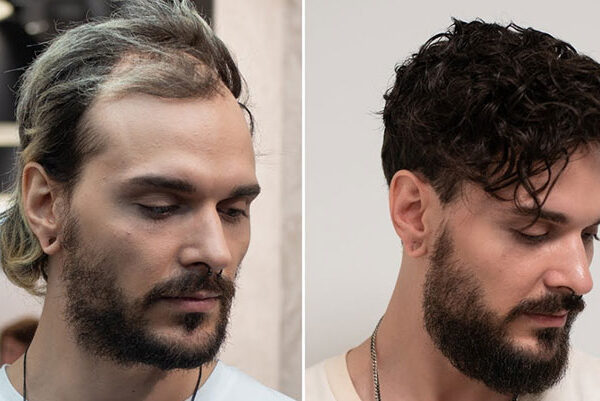 Hair Fixing Price in Kolkata