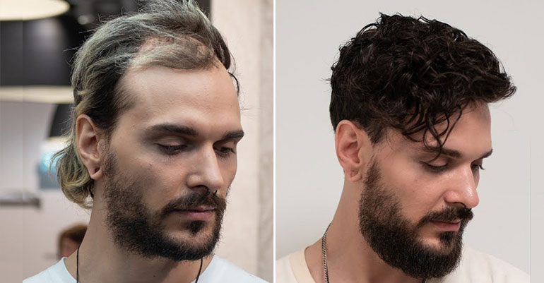 Hair Fixing Price in Kolkata