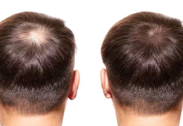 Hair Weaving Price in Kolkata