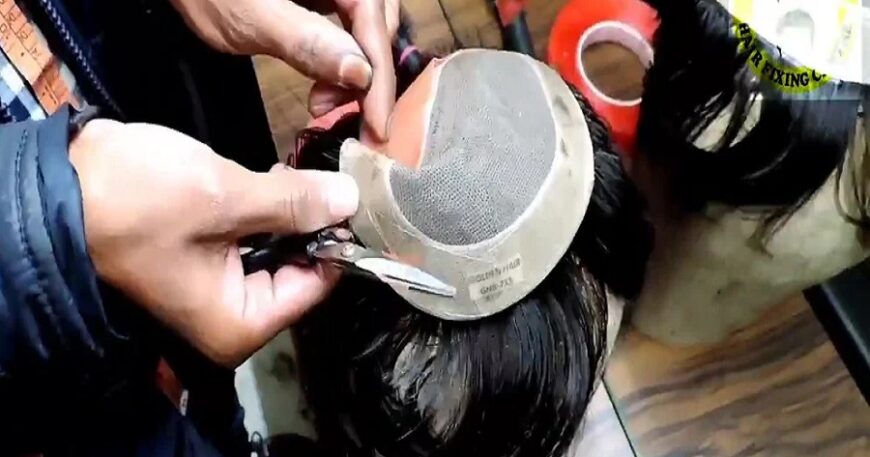 Affordable Hair Patch Services in Kolkata